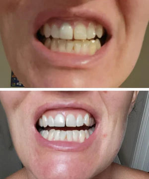 Meloura Purple Teeth Whitening Strips